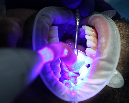 Jak przedłużyć efekt wybielania zębów?