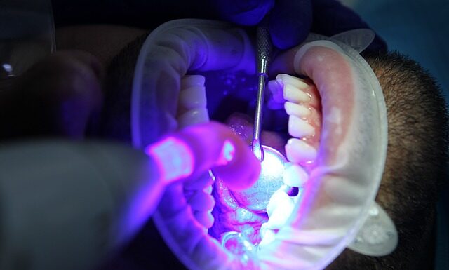 Jak przygotować zęby przed wybielaniem?
